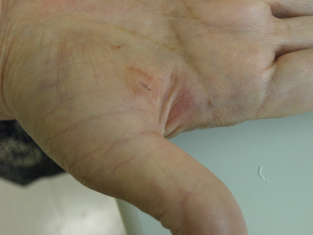 筋膜切開術に関するよくある質問