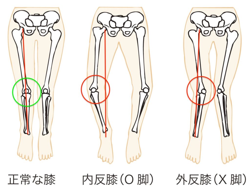 正常下肢、O脚、X脚