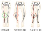 正常下肢、O脚、X脚