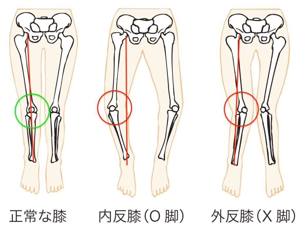 正常・O脚・X脚