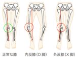 正常・O脚・X脚